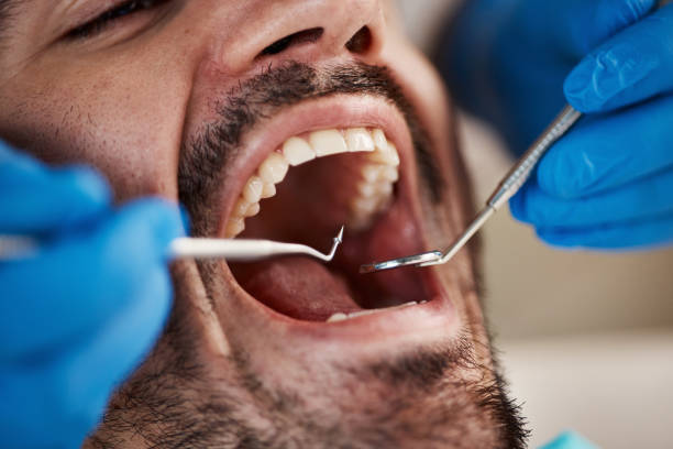 Best Emergency Dental Care for Broken or Chipped Teeth in Pinole, CA